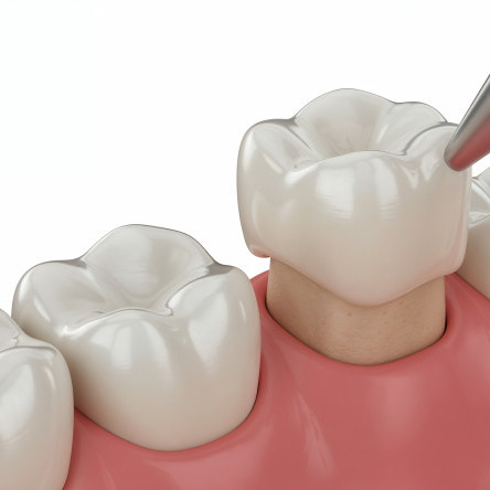 Thumbnail of Crowns
