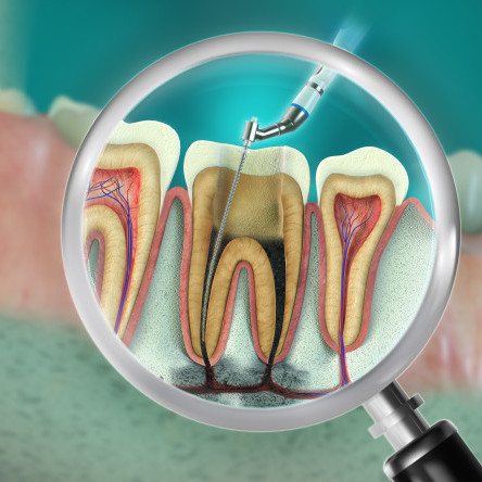 Thumbnail of Root Canal Treatment