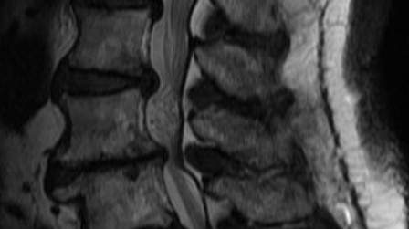 Figure 1b shows lumbar spinal stenosis and spondylolisthesis L5/S1.