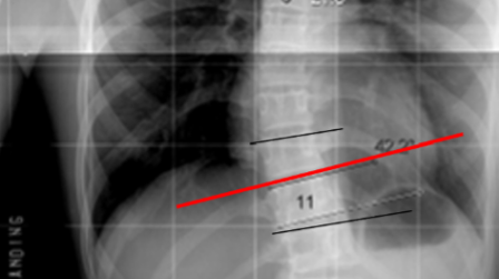 Figure 1. This X-ray shows how Cobb’s angle is measured.