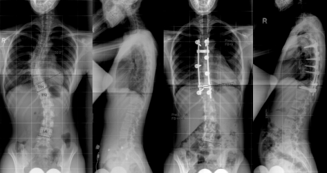 Figure 2. These X-ray images show preoperative and postoperative results of scoliosis surgery.