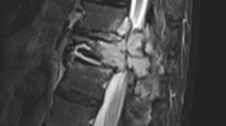 Figure 1. MRI image shows pericordal compression by a metastatic spinal tumour.
