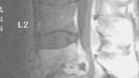 Figure 1. This MRI image shows typical bacterial infection at L3/4. The intervertebral disc was destroyed with the adjacent vertebral bodies.