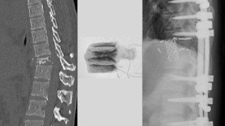 Figure 2. This patient had a locally aggressive vertebral tumour . A total en bloc excision was performed as a curative treatment to remove the tumour completely.