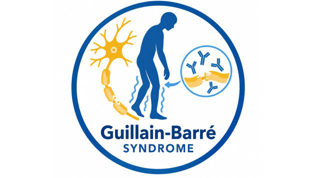 Thumbnail of Guillain-Barre Syndrome (GBS)