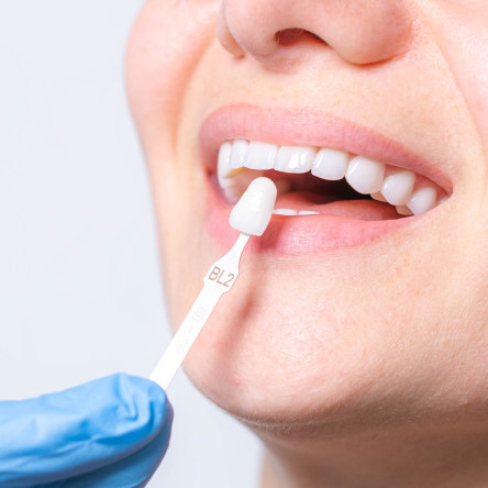 Thumbnail of Tooth Whitening