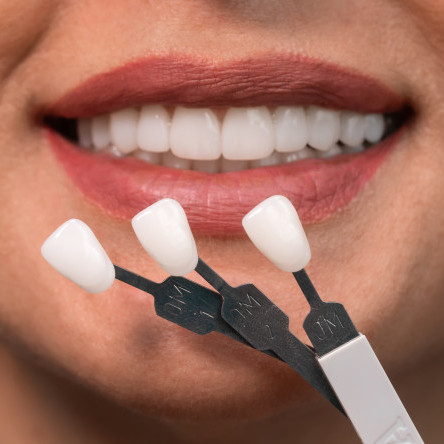 Thumbnail of Veneers