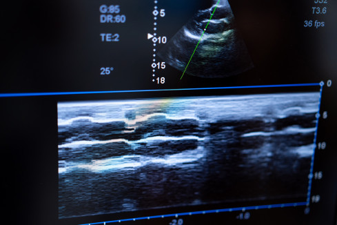 Thumbnail of Early Foetal Morphology Scan