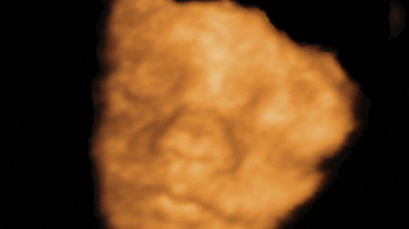 3D foetal face at 20 weeks