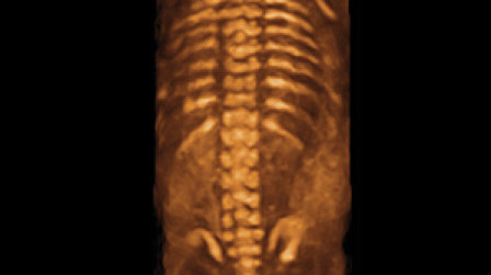 3D foetal spine at 20 weeks