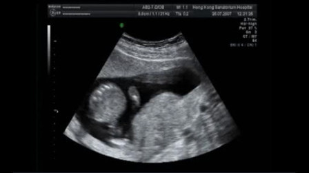 Amniocentesis