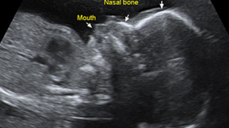 Facial profile in the second trimester