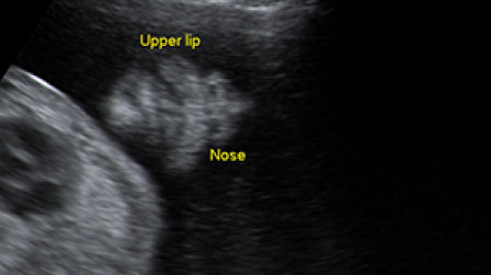 Fetal nose and lips in the second trimester