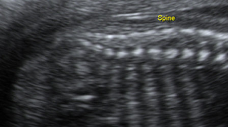 Fetal spine in the second trimester