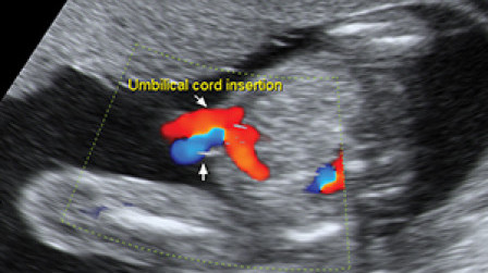 Umbilical cord insertion of the fetal abdomen