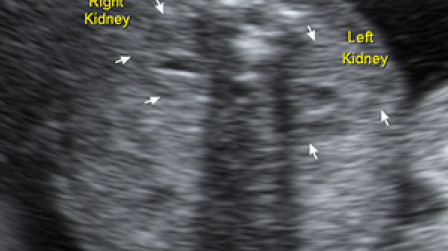 Two fetal kidneys