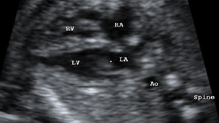 The 4-chamber view of fetal heart