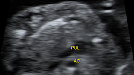 The 3 vessels’view of the fetal heart