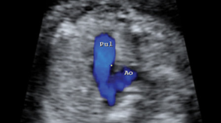 Colour flow of both pulmonary artery and aorta
