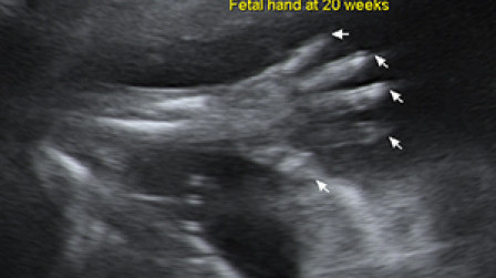 The fetal hand at 20 weeks