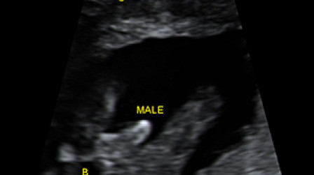 Male genital organ (arrow) at 18 weeks