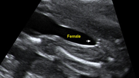 Female genital organ (arrow) at 20 weeks