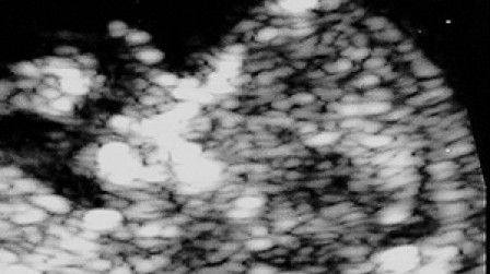 The nuchal translucency thickness in the first trimester