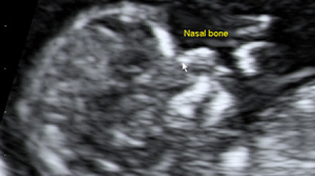 Facial profile in the first trimester