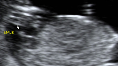 Male genital organ (arrow) at 12 weeks