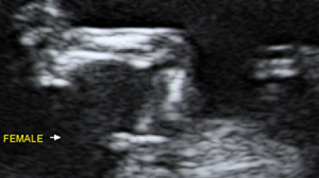 Female genital organ (arrow) at 12 weeks