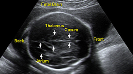 Fetal brain in the second trimester