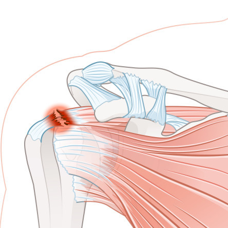 Thumbnail of Rotator Cuff Tendonitis