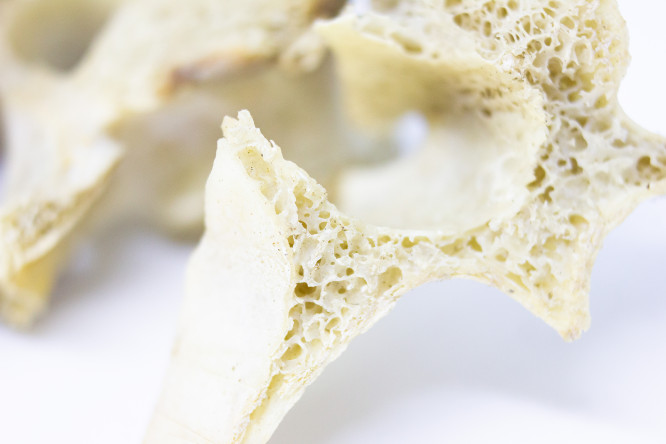 Thumbnail of What is osteoporosis?