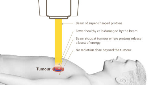 Thumbnail of Why Choose Proton Therapy?