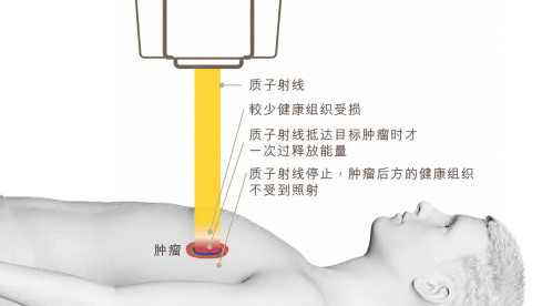 缩图 - 为何选择质子治疗?