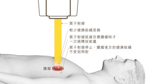 縮圖 - 為何選擇質子治療?