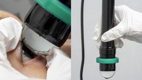 Thumbnail of Ultrasound Biomicroscopy (UBM)