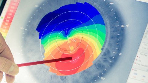 Thumbnail of Corneal Topography and Pachymetry