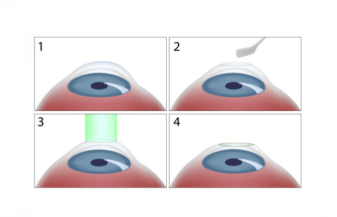 Thumbnail of Photo Refractive Keratectomy (PRK) and Transepithelial PhotoRefractive Keratectomy (Trans PRK)