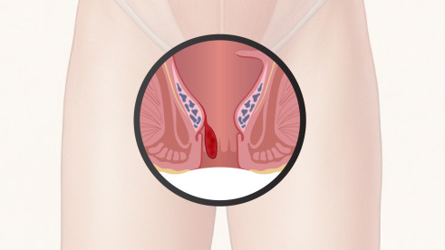 Thumbnail of Haemorrhoidal Surgery