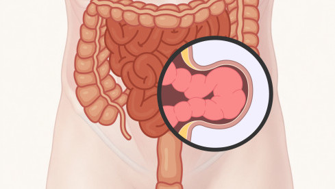 Thumbnail of Hernia Repair