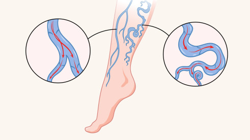 Thumbnail of Varicose Veins Surgery