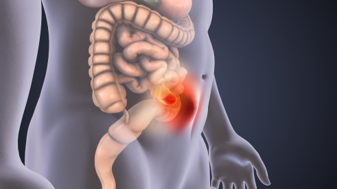 Thumbnail of Hernia Surgery