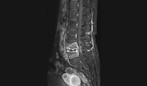 Thumbnail of Infection