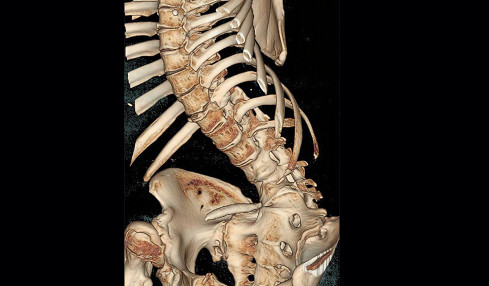 Thumbnail of Complex Spinal Problems