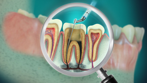 Thumbnail of Root Canal Treatment