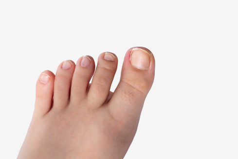 Thumbnail of Toenail Conditions