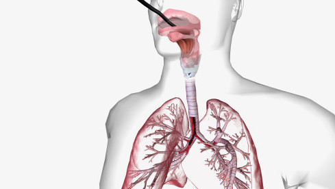 Thumbnail of Diagnostic Bronchoscopy