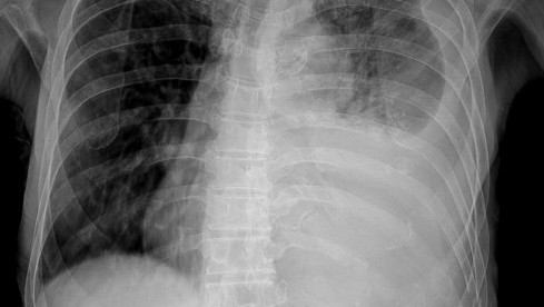 Thumbnail of Diagnosis of Pleural Diseases (Pneumothorax and Pleural Effusion)