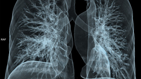 Thumbnail of Lung Nodules